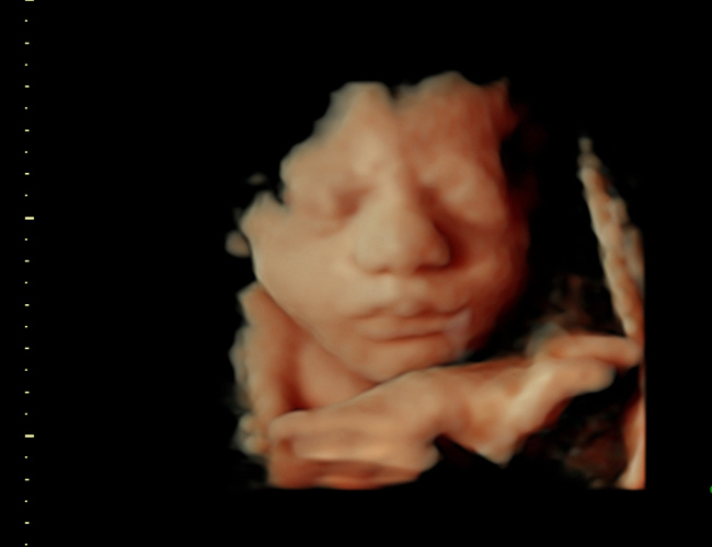 3D ultrasound image at 31 weeks